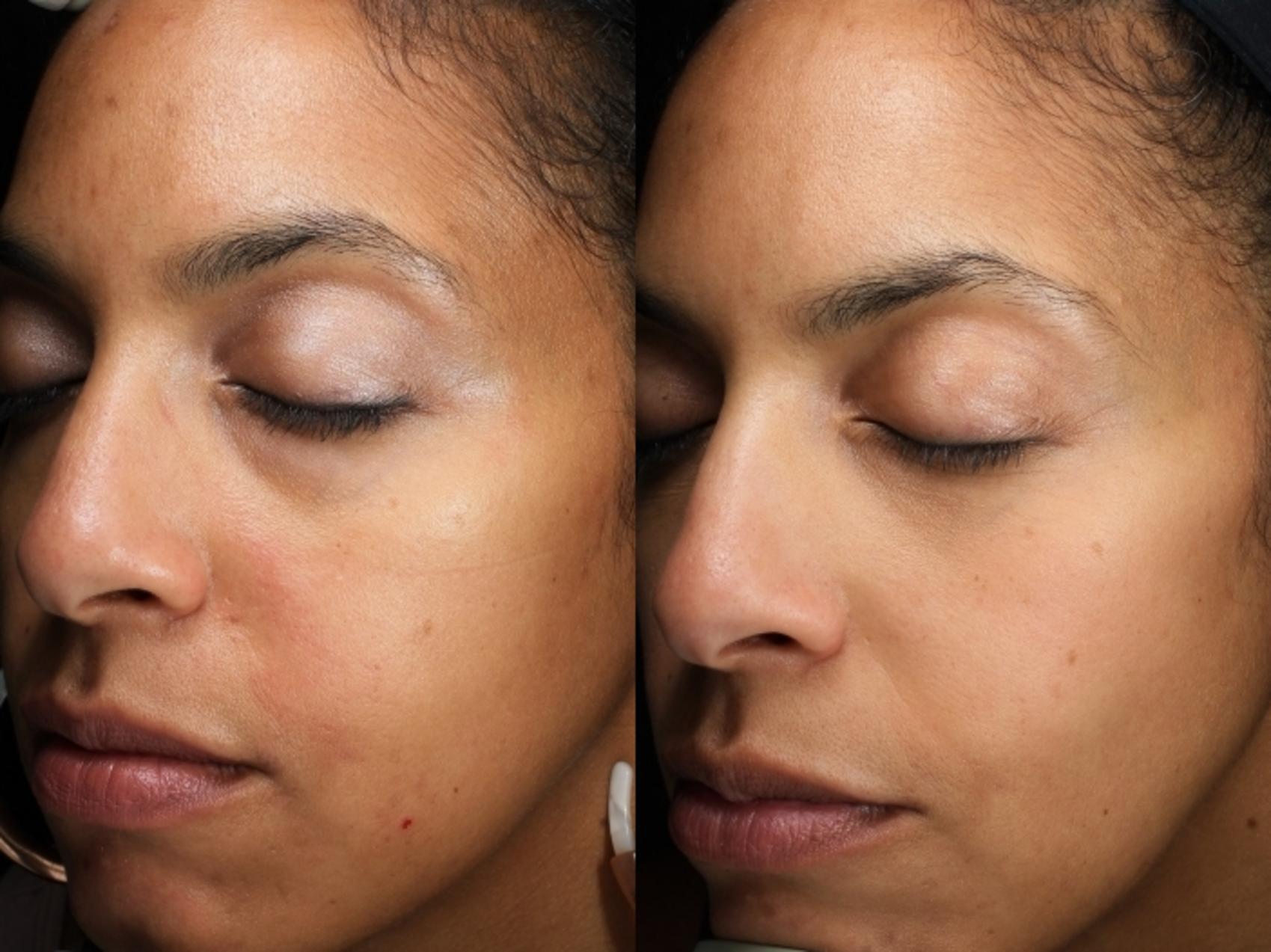 Chemical Peels Case 210 Before & After Left Oblique | Rochester & Victor, NY | Q the Medical Spa