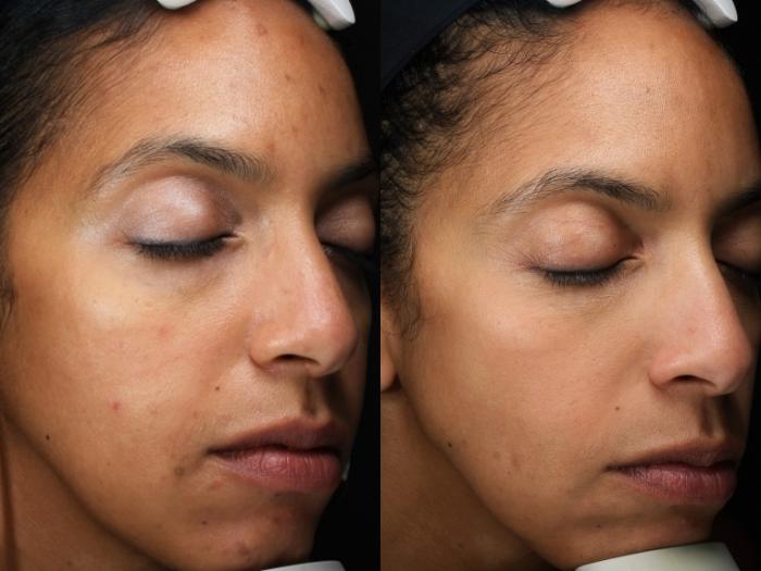 Chemical Peels Case 210 Before & After Right Oblique | Rochester & Victor, NY | Q the Medical Spa