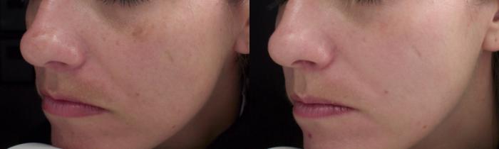 Chemical Peels Case 49 Before & After View #1 | Rochester & Victor, NY | Q the Medical Spa
