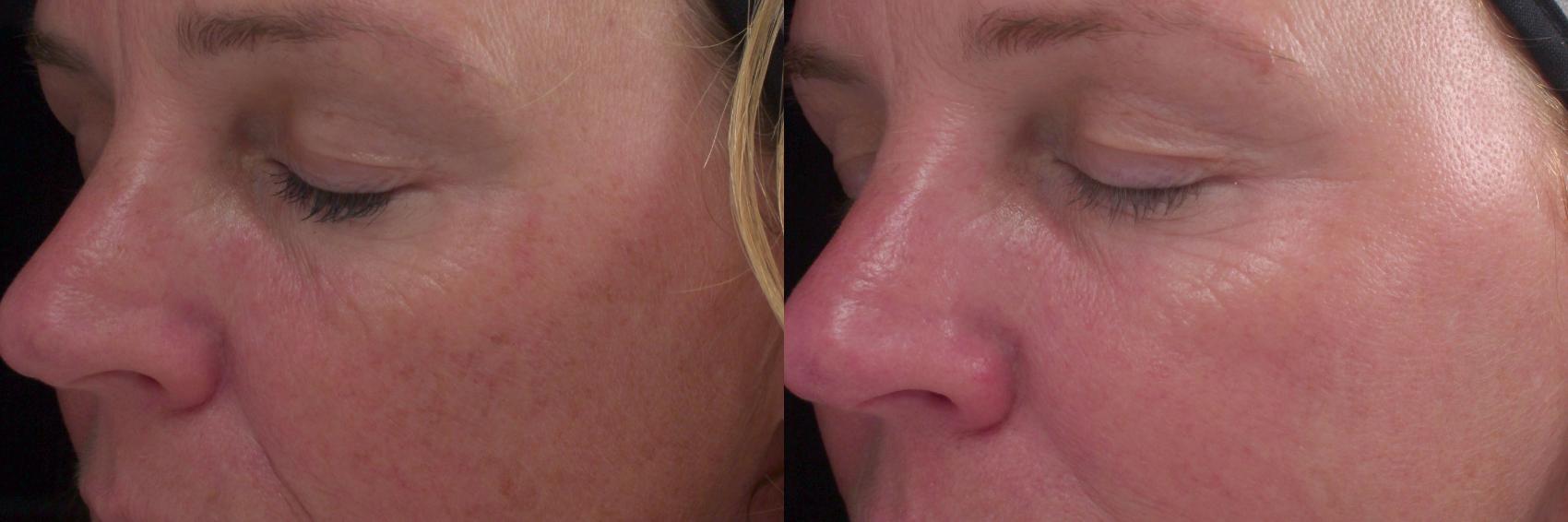 Chemical Peels Case 54 Before & After View #1 | Rochester, NY | Q the Medical Spa