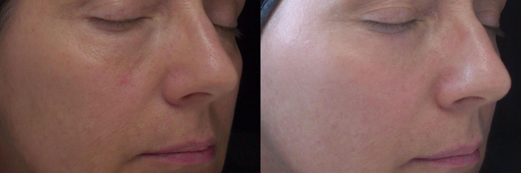Chemical Peels Case 57 Before & After View #1 | Rochester, NY | Q the Medical Spa