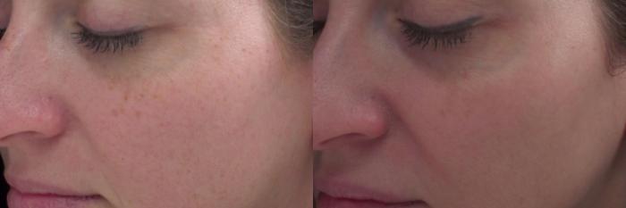 Chemical Peels Case 58 Before & After View #1 | Rochester & Victor, NY | Q the Medical Spa