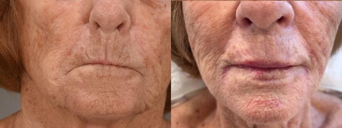 Lip Filler Case 222 Before & After Front | Rochester, NY | Q the Medical Spa