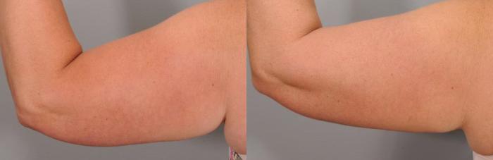 CoolSculpting® Case 122 Before & After View #1 | Rochester, NY | Q the Medical Spa