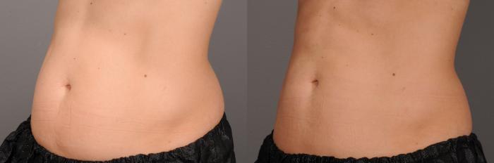 CoolSculpting® Case 136 Before & After View #1 | Rochester, NY | Q the Medical Spa