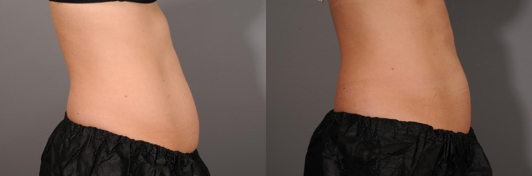 CoolSculpting® Case 136 Before & After View #2 | Rochester, NY | Q the Medical Spa