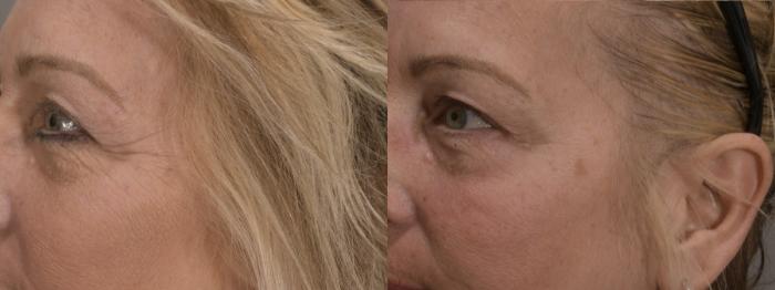 Glabella Case 164 Before & After Right Oblique | Rochester, NY | Q the Medical Spa