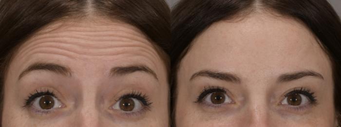 Forehead Case 165 Before & After Front | Rochester, NY | Q the Medical Spa
