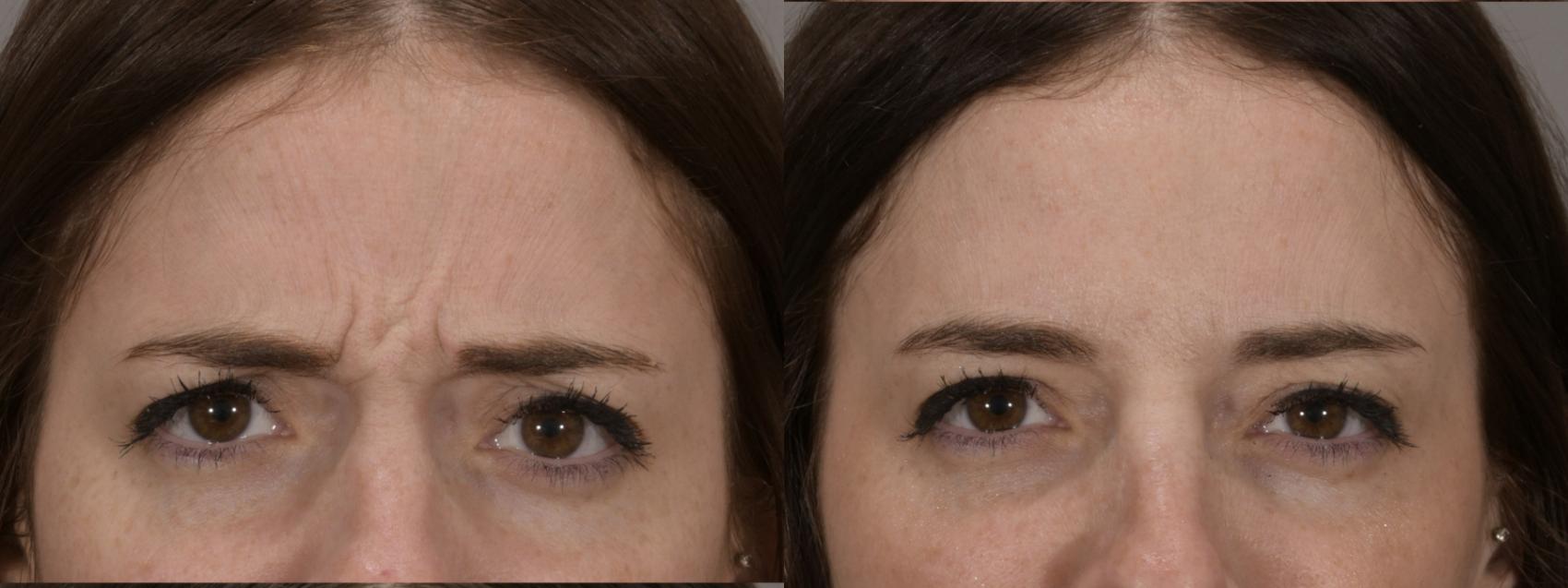 Forehead Case 165 Before & After Glabellar | Rochester, NY | Q the Medical Spa