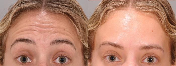 Forehead Case 166 Before & After Front | Rochester, NY | Q the Medical Spa