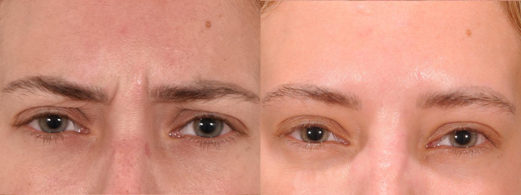 Forehead Case 166 Before & After Glabellar | Rochester, NY | Q the Medical Spa