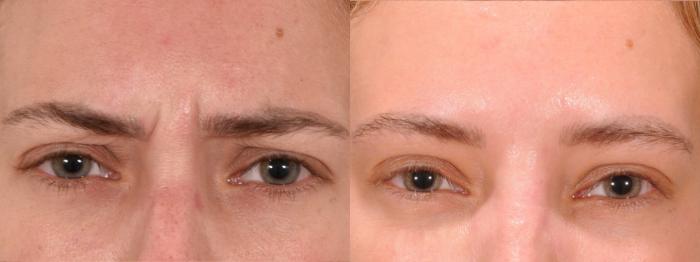 Forehead Case 166 Before & After Glabellar | Rochester, NY | Q the Medical Spa