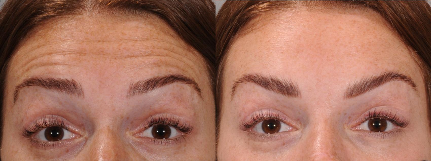 Forehead Case 167 Before & After Front | Rochester, NY | Q the Medical Spa