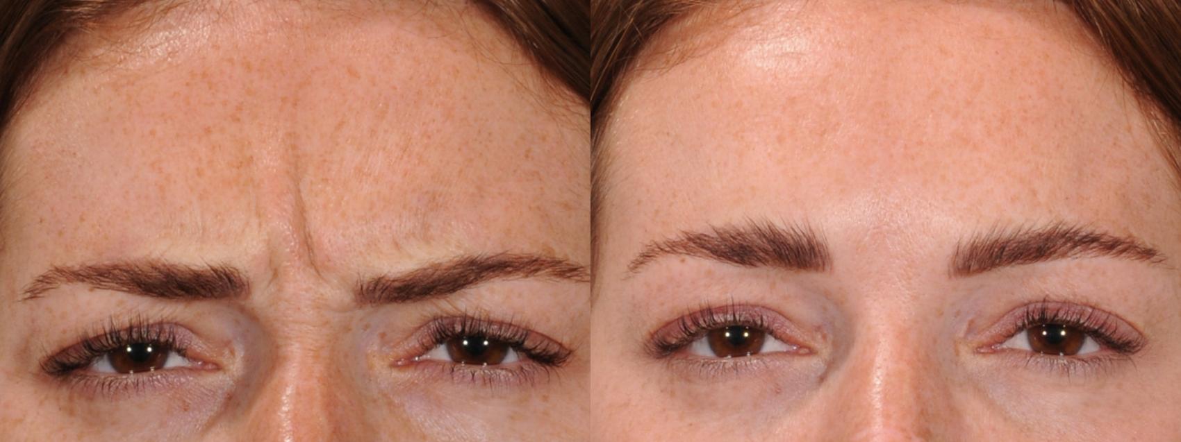 Forehead Case 167 Before & After Glabellar | Rochester, NY | Q the Medical Spa