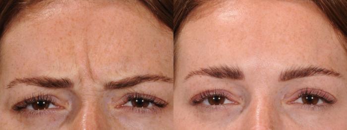 Forehead Case 167 Before & After Glabellar | Rochester, NY | Q the Medical Spa
