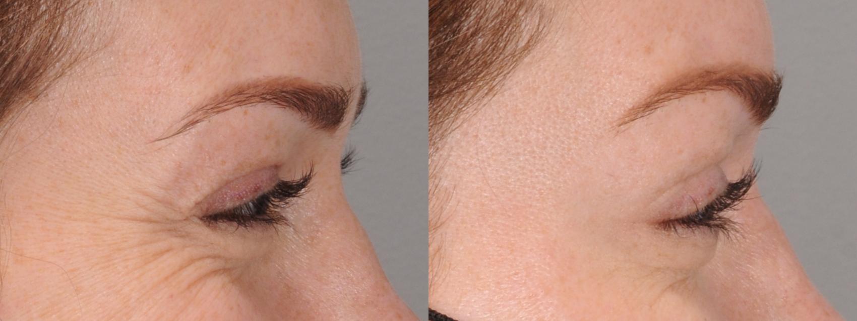 Forehead Case 167 Before & After Right Side | Rochester, NY | Q the Medical Spa