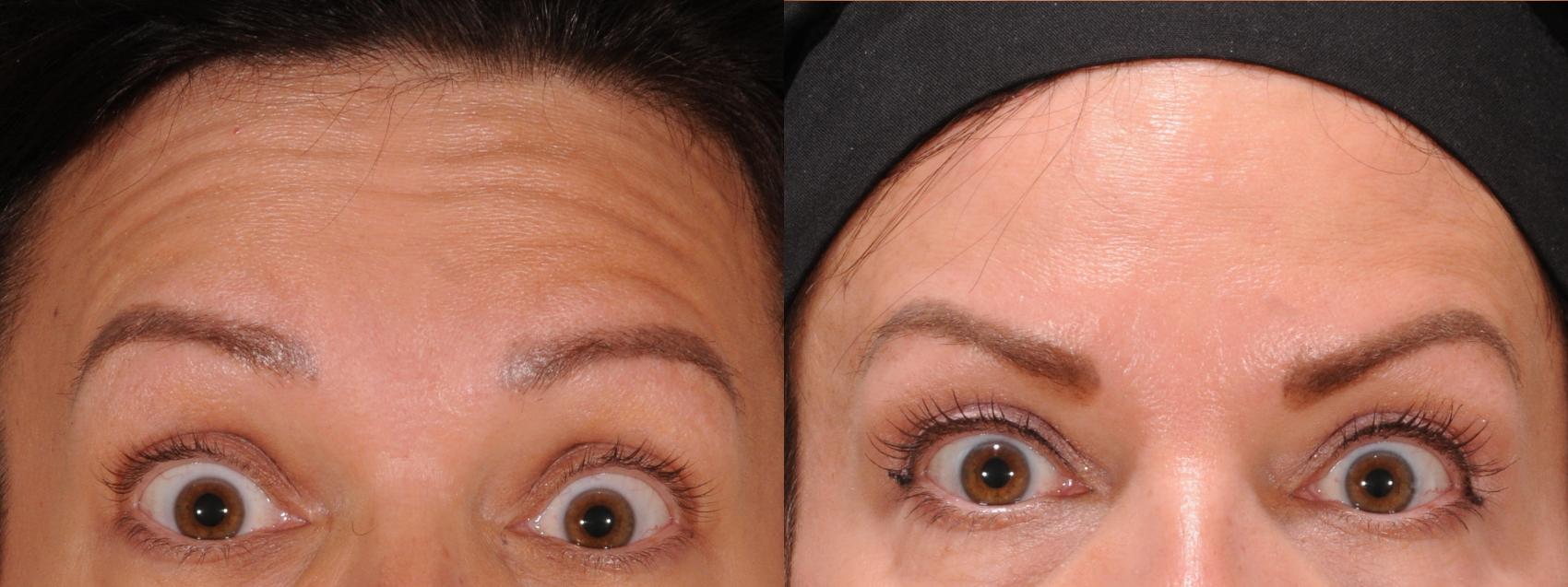 Forehead Case 172 Before & After Front | Rochester, NY | Q the Medical Spa