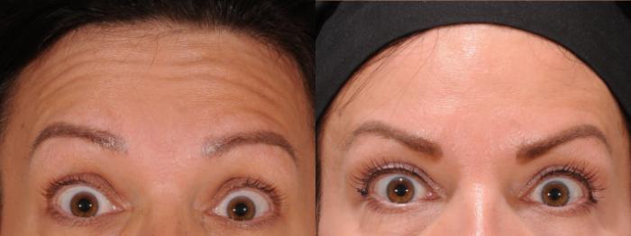 Forehead Case 172 Before & After Front | Rochester, NY | Q the Medical Spa