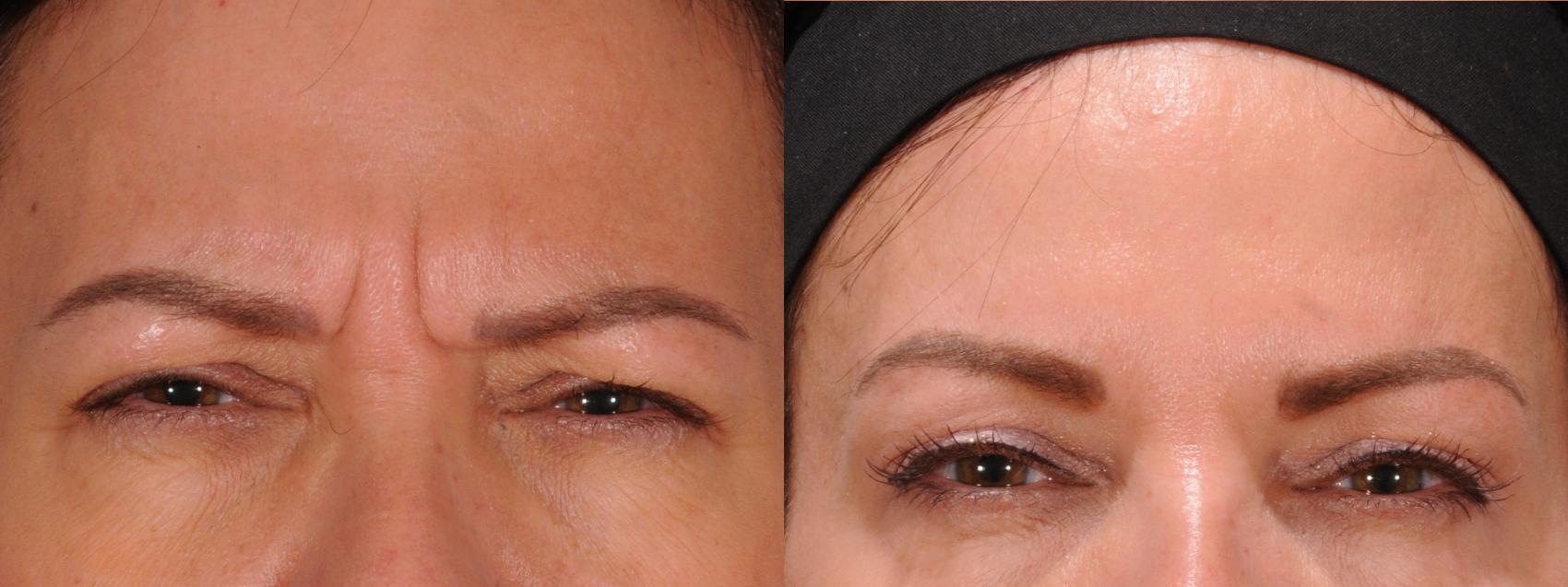 Forehead Case 172 Before & After Glabellar | Rochester, NY | Q the Medical Spa