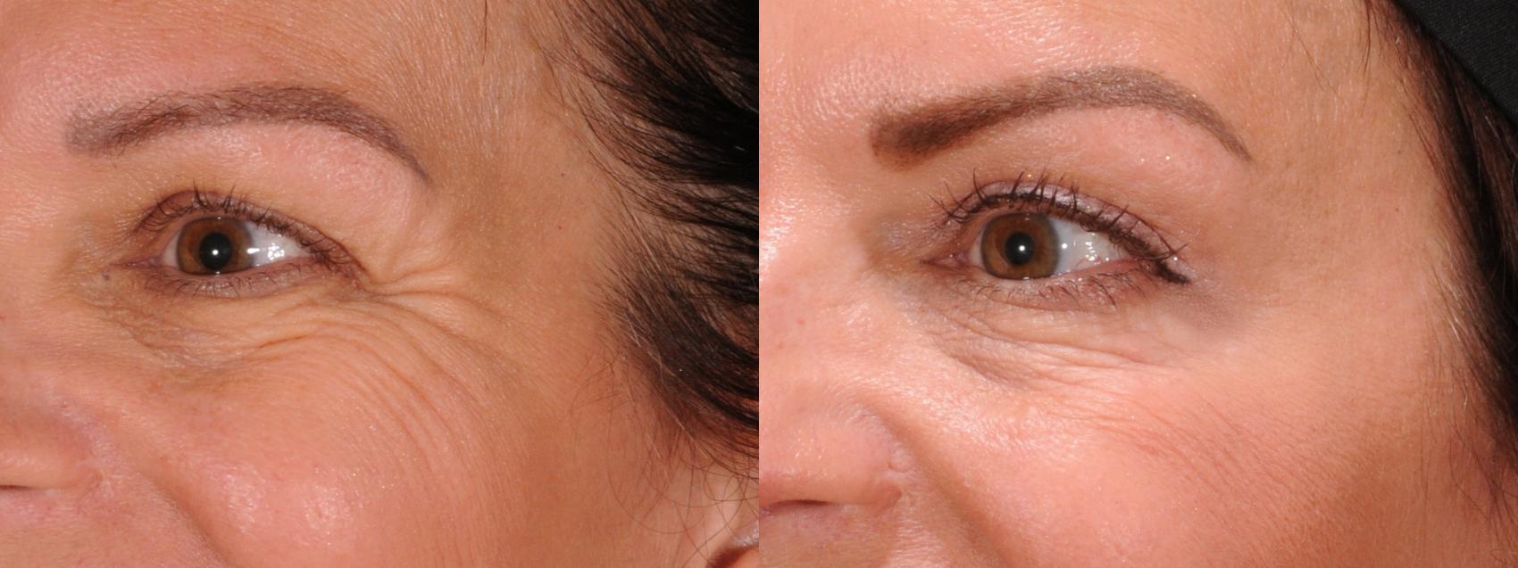 Forehead Case 172 Before & After Left Oblique | Rochester, NY | Q the Medical Spa