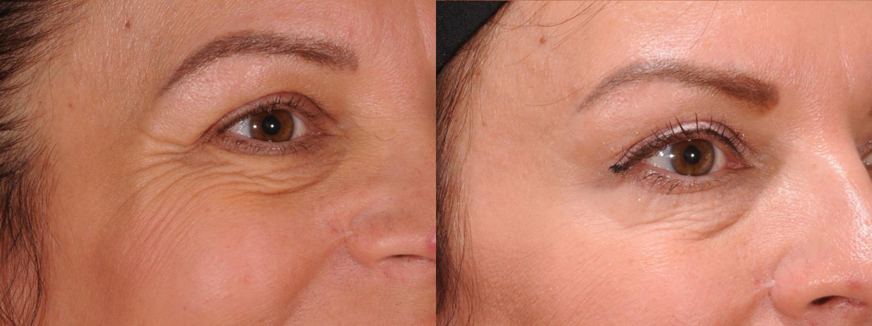 Forehead Case 172 Before & After Right Oblique | Rochester, NY | Q the Medical Spa