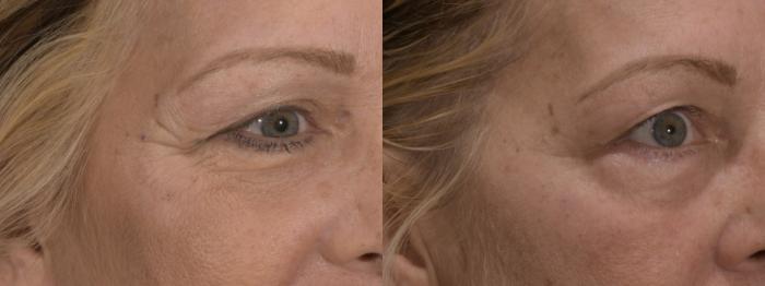 Crow's Feet Botox Case 164 Before & After Left Oblique | Rochester, NY | Q the Medical Spa