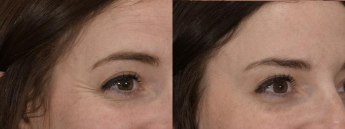 Crow's Feet Botox Case 165 Before & After Left Oblique | Rochester, NY | Q the Medical Spa
