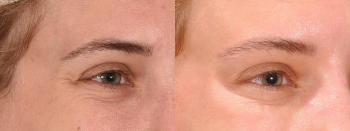 Crow's Feet Botox Case 166 Before & After Left Oblique | Rochester, NY | Q the Medical Spa
