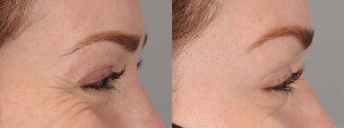 Crow's Feet Botox Case 167 Before & After Right Side | Rochester, NY | Q the Medical Spa