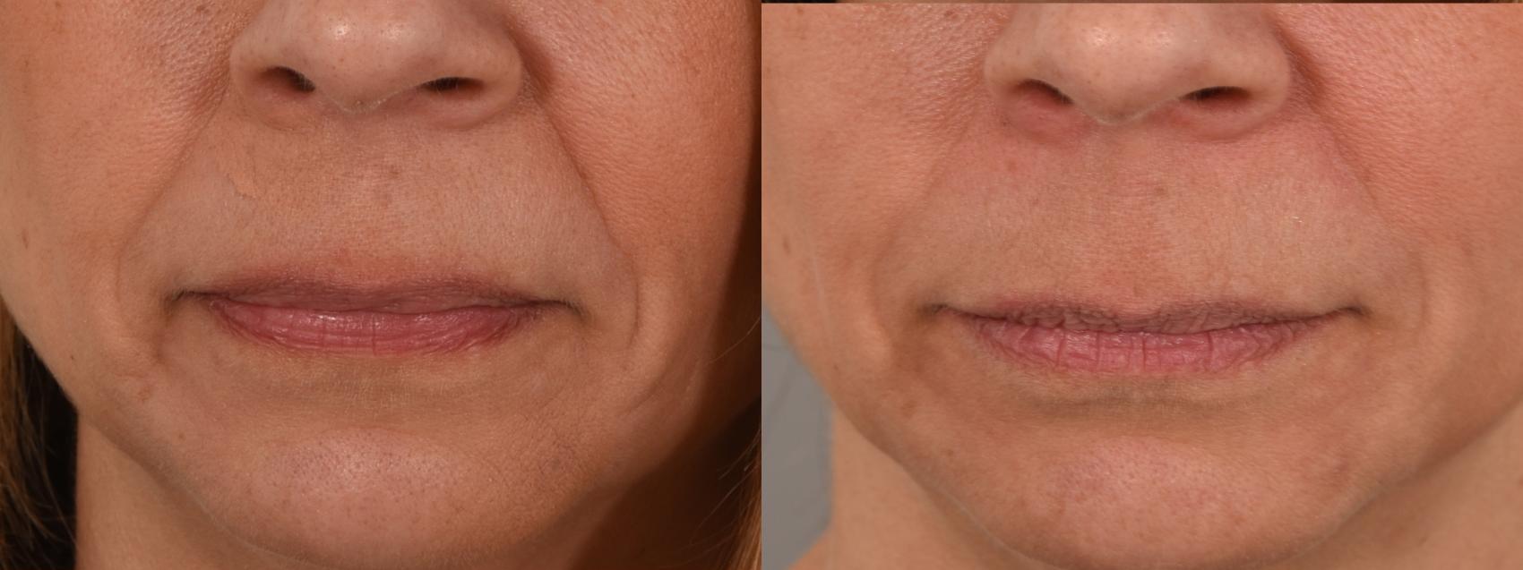 Dermal Fillers Case 193 Before & After Front | Rochester & Victor, NY | Q the Medical Spa