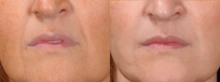 Dermal Fillers Case 194 Before & After Front | Rochester & Victor, NY | Q the Medical Spa