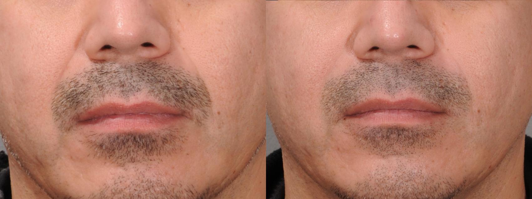 Dermal Fillers Case 195 Before & After Front | Rochester & Victor, NY | Q the Medical Spa