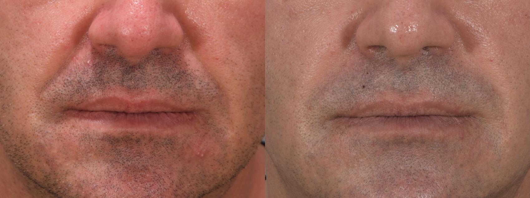 Dermal Fillers Case 196 Before & After Front | Rochester & Victor, NY | Q the Medical Spa