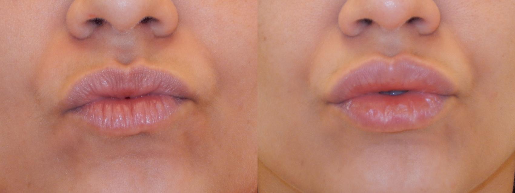 Dermal Fillers Case 96 Before & After View #2 | Rochester, NY | Q the Medical Spa