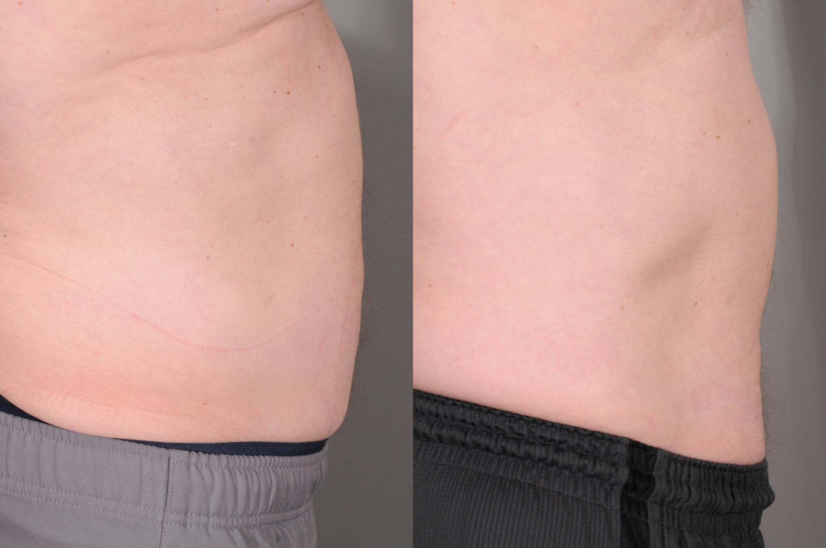 EMSCULPT® Case 113 Before & After View #2 | Rochester, NY | Q the Medical Spa