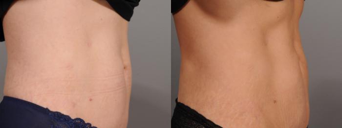 EMSCULPT® & EMSCULPTNEO® Case 124 Before & After View #1 | Rochester & Victor, NY | Q the Medical Spa