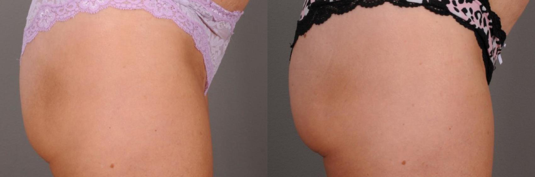 EMSCULPT® & EMSCULPTNEO® Case 133 Before & After View #1 | Rochester & Victor, NY | Q the Medical Spa