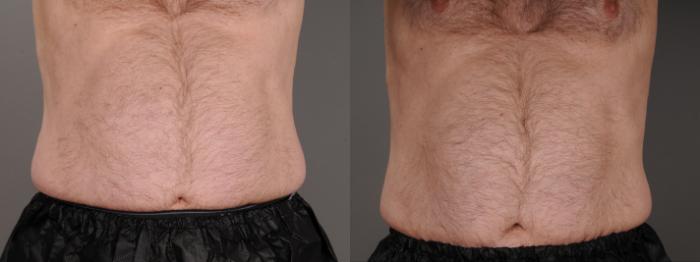 EMSCULPT® & EMSCULPT NEO® Case 245 Before & After Front | Rochester, NY | Q the Medical Spa