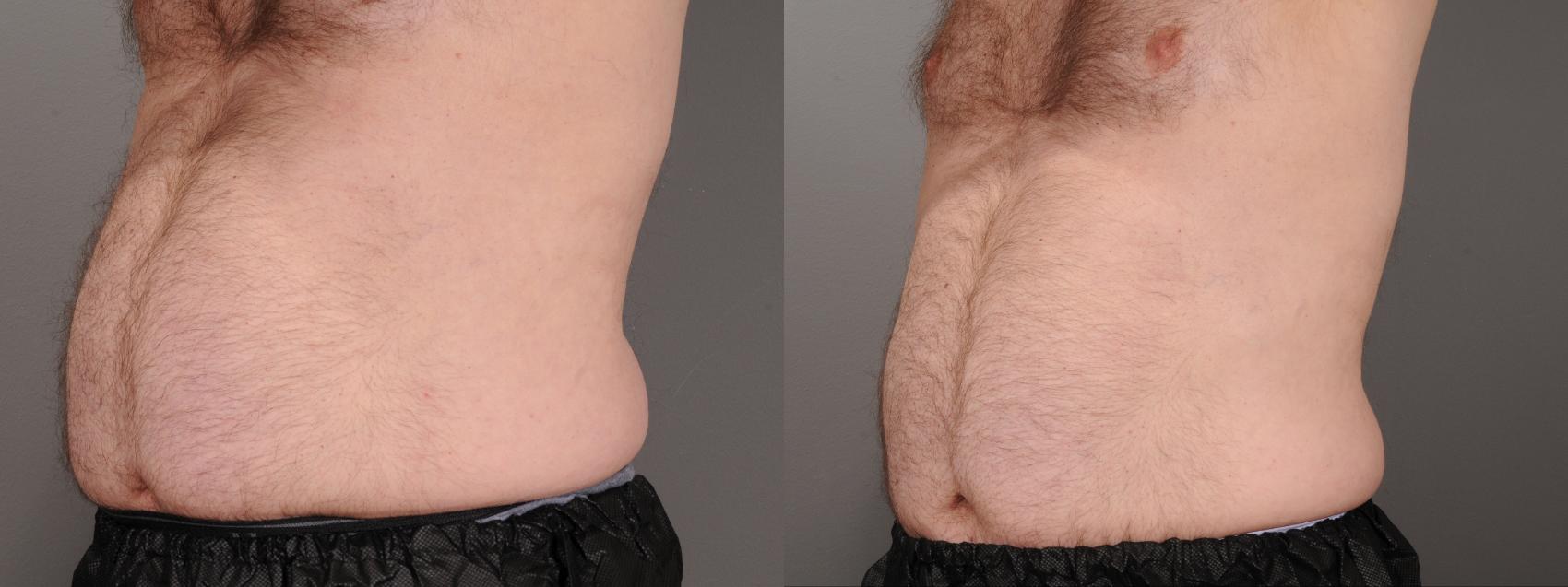 EMSCULPT® & EMSCULPT NEO® Case 245 Before & After Left Oblique | Rochester, NY | Q the Medical Spa