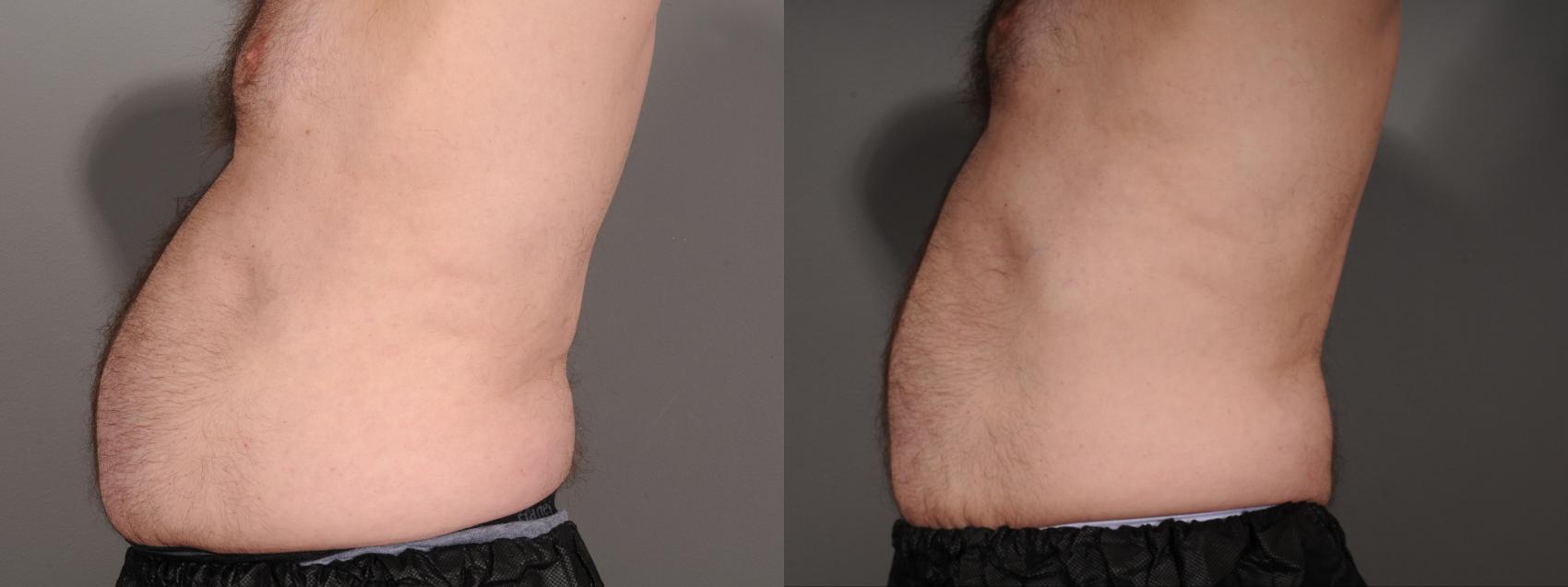 EMSCULPT® & EMSCULPT NEO® Case 245 Before & After Left Side | Rochester, NY | Q the Medical Spa