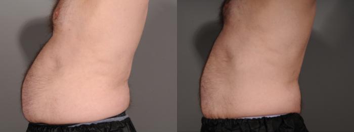 EMSCULPT® & EMSCULPT NEO® Case 245 Before & After Left Side | Rochester, NY | Q the Medical Spa