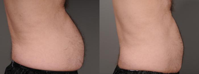 EMSCULPT® & EMSCULPT NEO® Case 245 Before & After Right Side | Rochester, NY | Q the Medical Spa