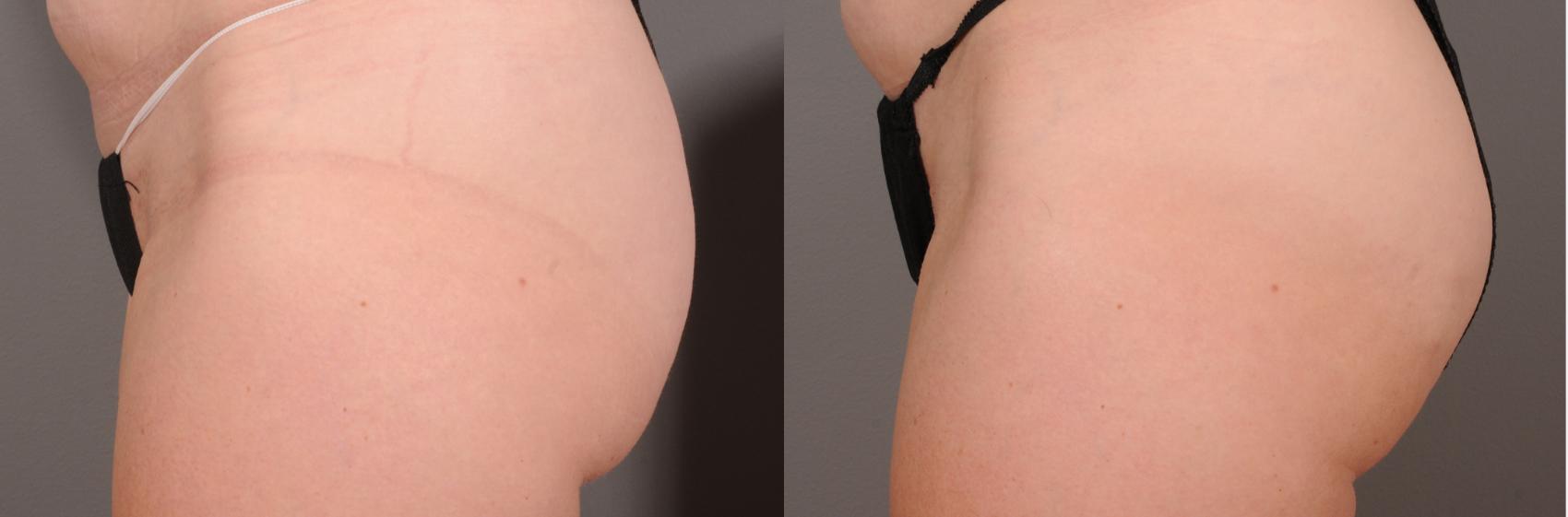 EMSCULPT® & EMSCULPT NEO® Case 246 Before & After Left Side | Rochester, NY | Q the Medical Spa