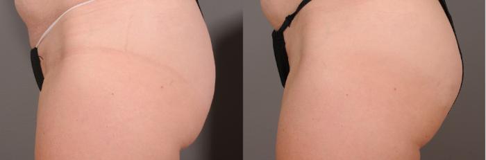 EMSCULPT® & EMSCULPT NEO® Case 246 Before & After Left Side | Rochester, NY | Q the Medical Spa