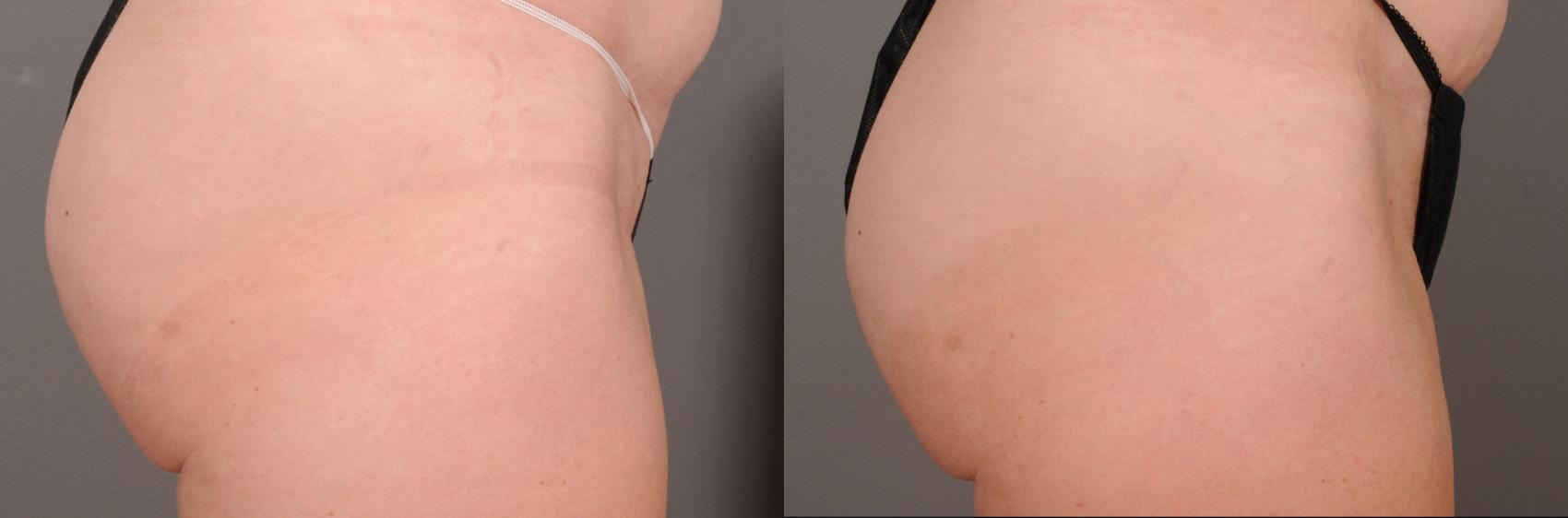 EMSCULPT® & EMSCULPT NEO® Case 246 Before & After Right Side | Rochester, NY | Q the Medical Spa