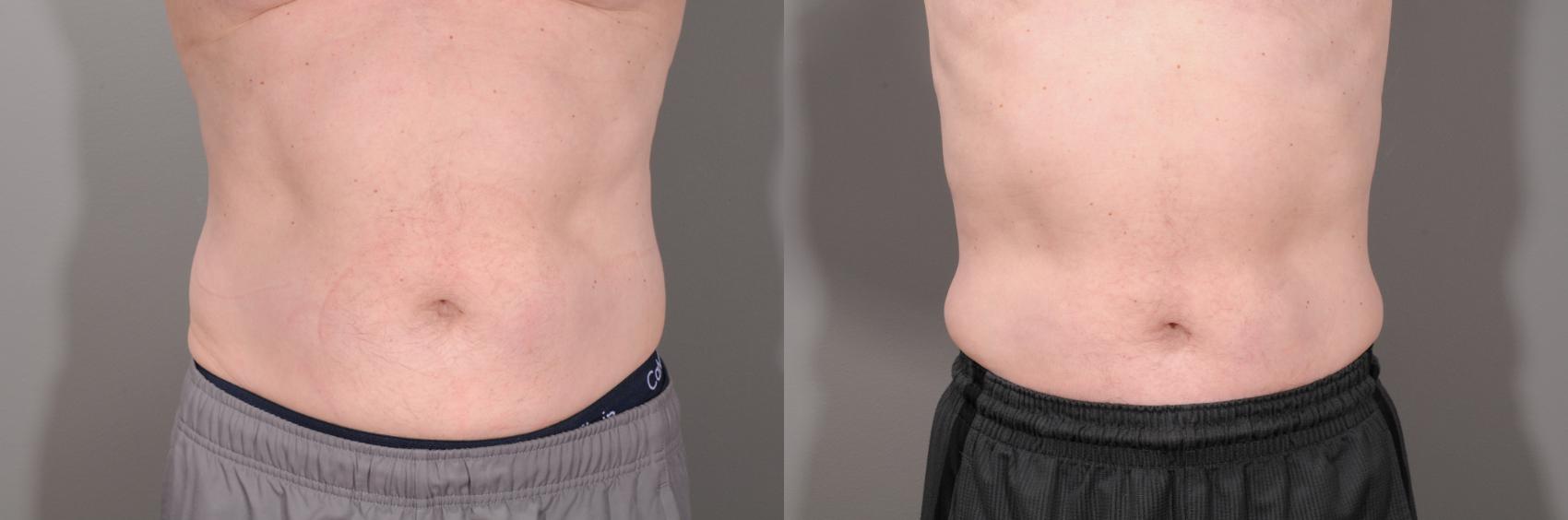 EMSCULPT® & EMSCULPT NEO® Case 113 Before & After View #1 | Rochester, NY | Q the Medical Spa