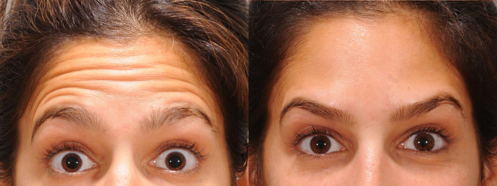 Forehead Case 156 Before & After Front | Rochester, NY | Q the Medical Spa