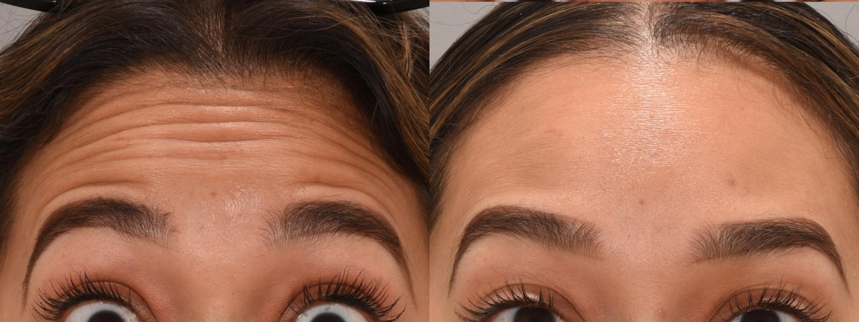 Forehead Case 157 Before & After Front | Rochester, NY | Q the Medical Spa