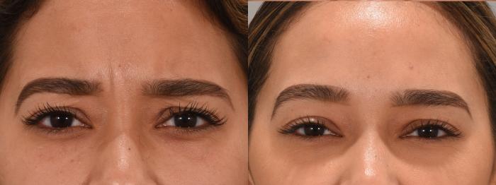 Forehead Case 157 Before & After Glabellar | Rochester, NY | Q the Medical Spa