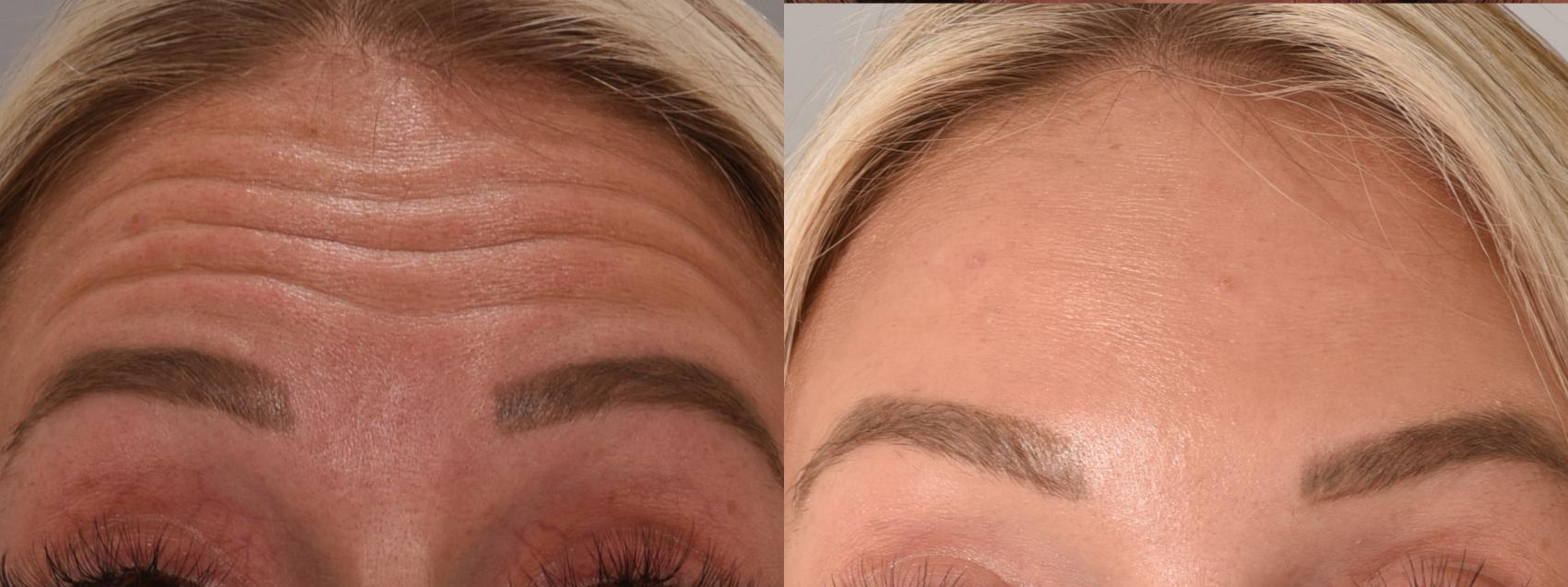 Forehead Case 158 Before & After Front | Rochester, NY | Q the Medical Spa